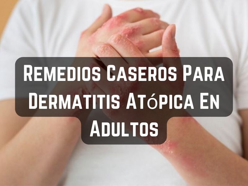 Remedios Caseros Para Dermatitis Atópica En Adultos
