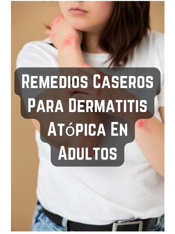 Remedios Caseros Para Dermatitis Atópica En Adultos